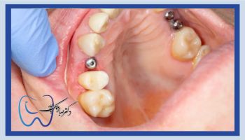 اثر سیگار روی ایمپلنت دندان