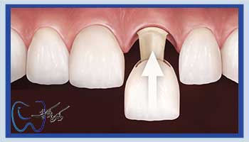 نحوه تراش دندان جلو برای روکش